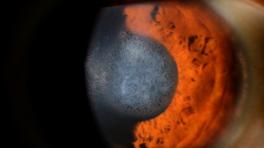 Distrofia corneal